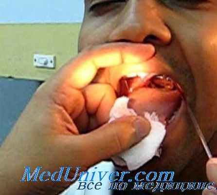 ларингоскопия