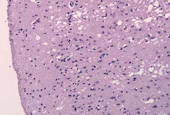 Ткани головного мозга пациента с болезнью Крейтцфельдта-Якоба