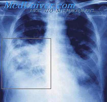 Рентгенограмма при пневмонии нижней доли правого легкого