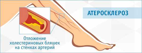 Атеросклероз артерий