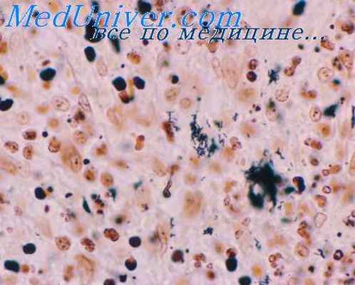 клиника фелиноза