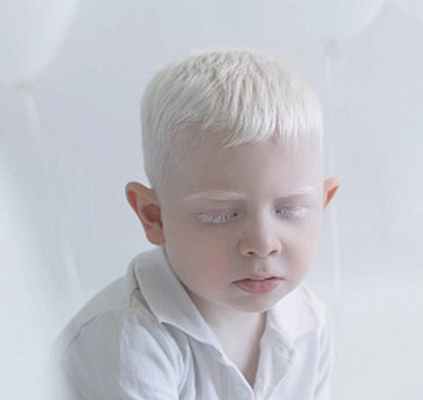 Фенилкетонурия