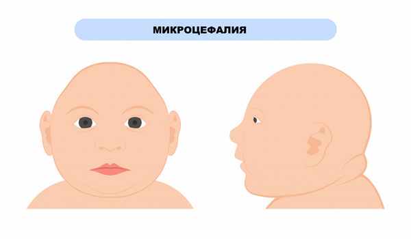 Микроцефалия.jpg