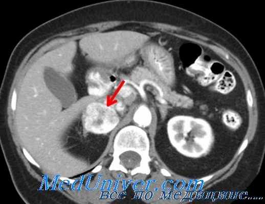 феохромоцитома