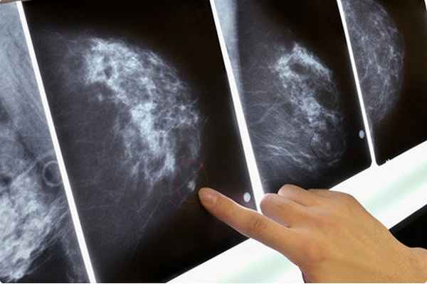 Диагностика фиброаденомы молочной железы