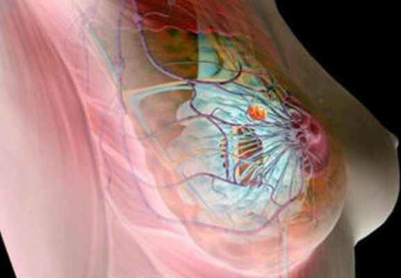 Фото 2 - Фиброаденома молочной железы