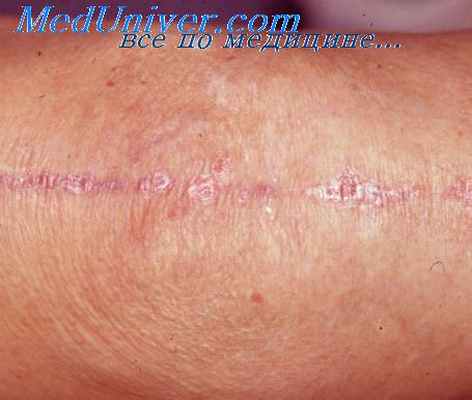 фиброзная ткань