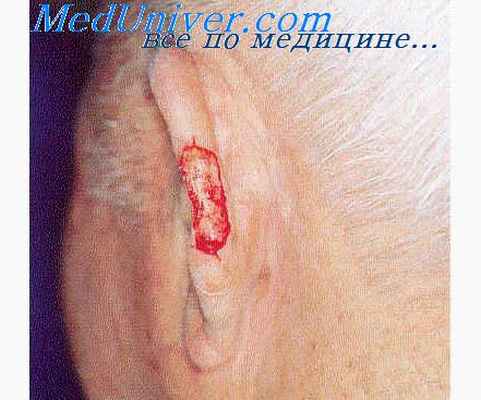 фиброгистиоцитарная опухоль