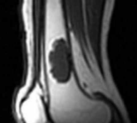 Энхондрома коленного сустава