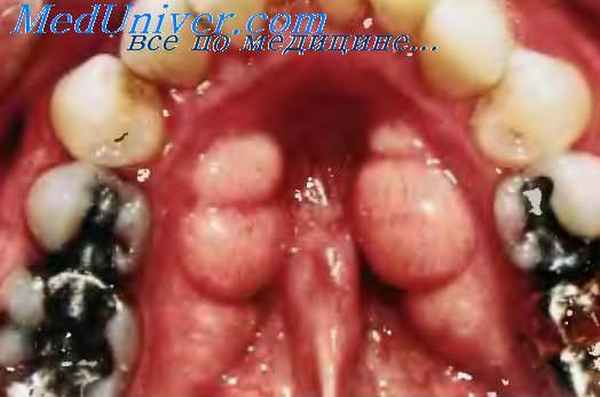 Валики полости рта