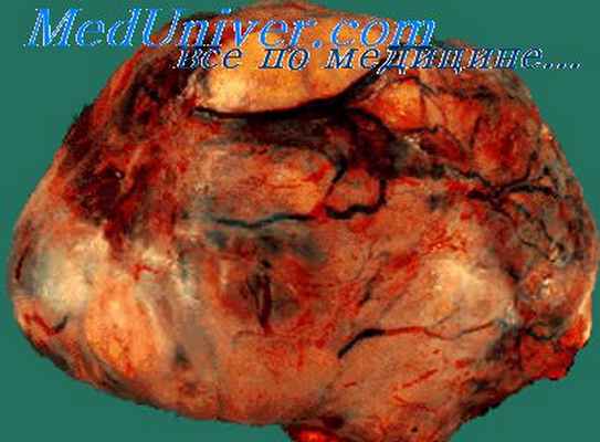 фиброма яичников