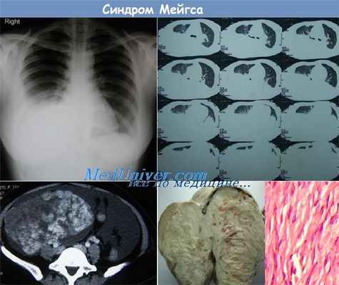синдром Мейгса