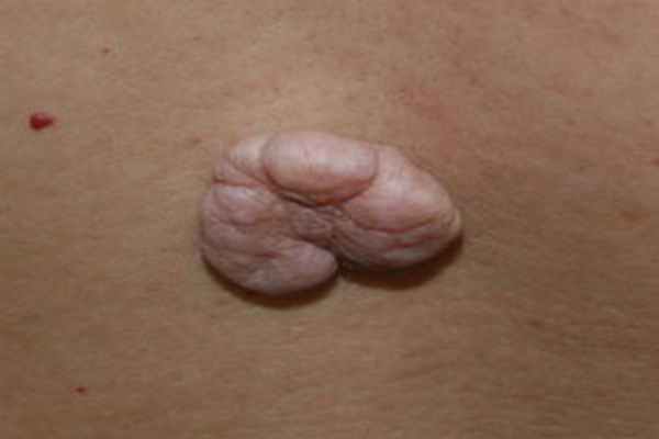 Фиброма кожи