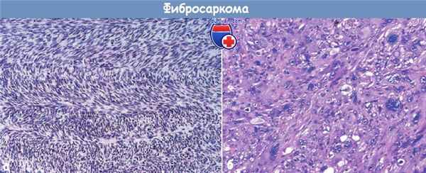 Фибросаркома