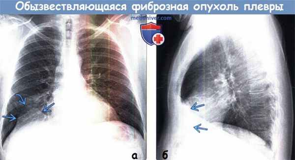 Обызвествляющаяся фиброзная опухоль плевры на рентгенограмме