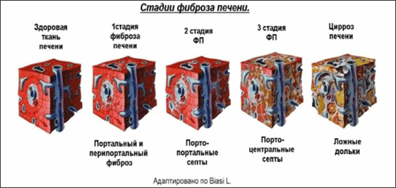 Степени фиброза печени