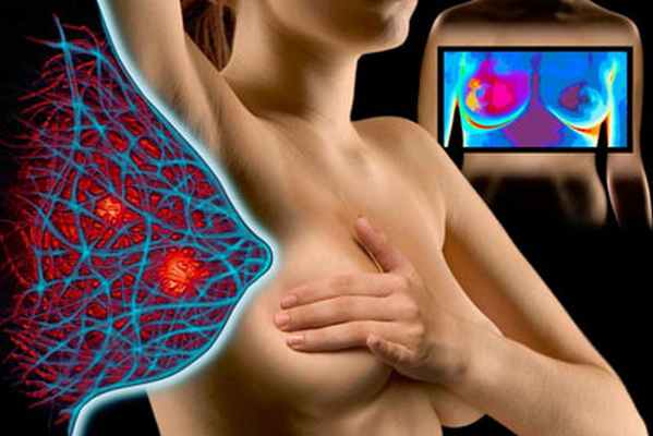 мастопатия диагностика картинка