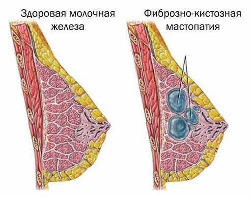 мастопатия схематично