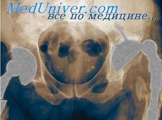 гиперостозы костей