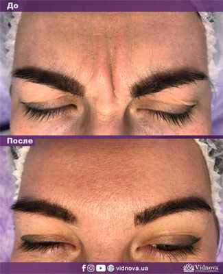 Процедура ботулинотерапии, инъекции Диспорта, фото до-после