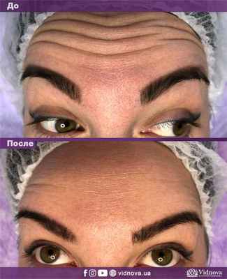 Процедура ботулинотерапии, инъекции Диспорта, фото до-после
