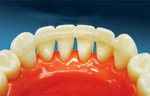 Шинирование зубов