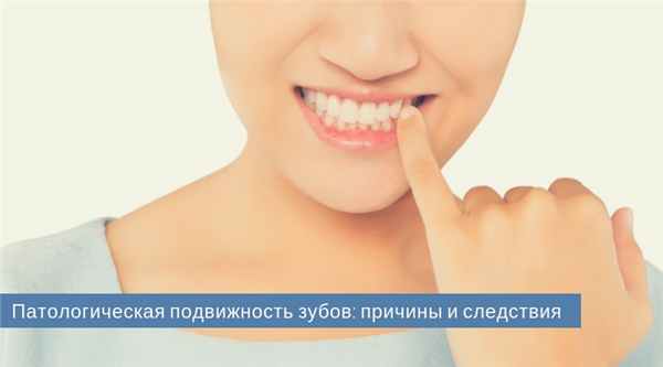 Подвижность зубов