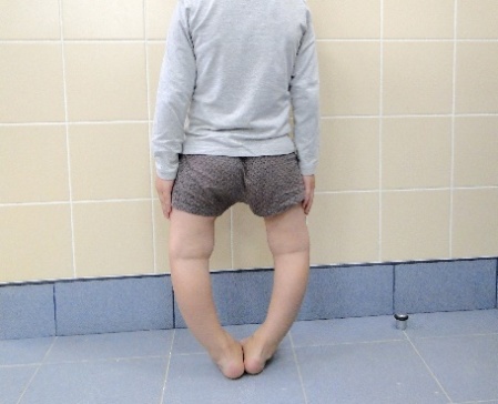 Варусная и вальгусная деформации коленных суставов