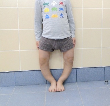 Варусная и вальгусная деформации коленных суставов