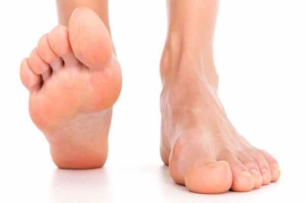 Плоскостопие