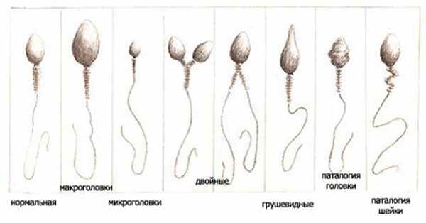 Аномалии в строении сперматозоидов