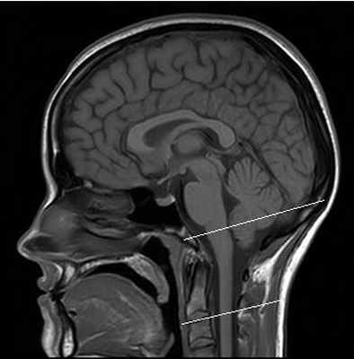 МРТ краниовертебрального перехода