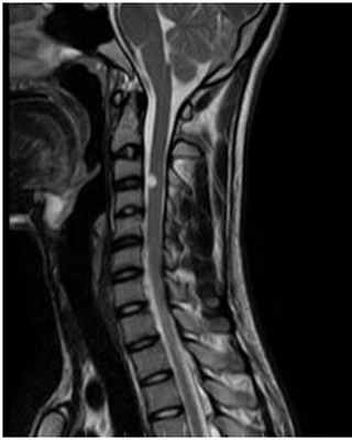 МРТ снимок шейного отдела позвоночника