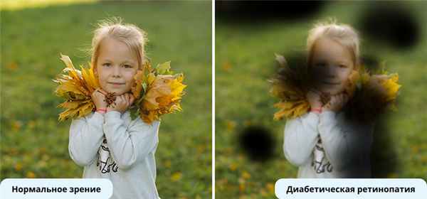 Как видит человек с диабетической ретинопатией