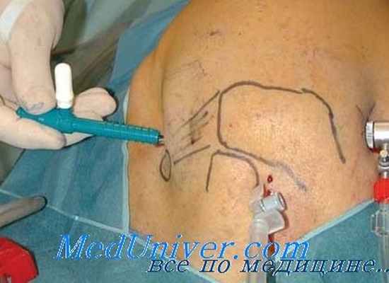 операция при плече-лопаточном периартрите