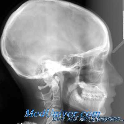 флегмона глазницы