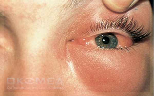 О лечении флегмоны глазной орбиты