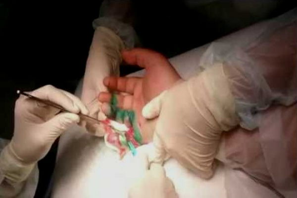 Таблица 3. Средние значения результатов лечения, измеряемые в днях, больных I и II клинической групп с флегмоной кисти