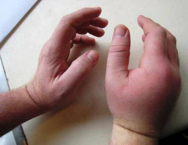 Таблица 4. Результаты оперативного лечения больных I и II клинической групп 