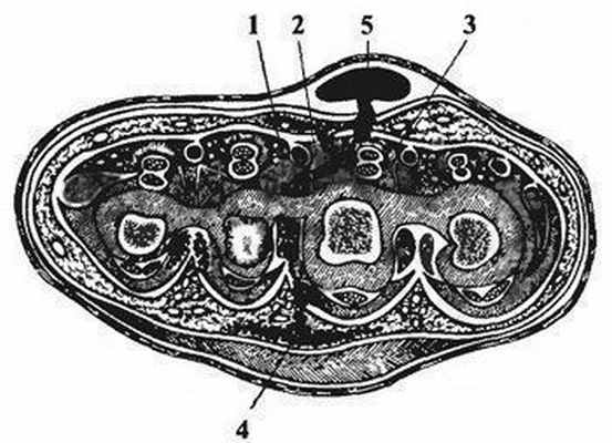 Пути распространения гноя при мозольном абсцессе кисти