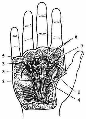Возможное распространение гноя при запушенной комиссуральной флегмоне