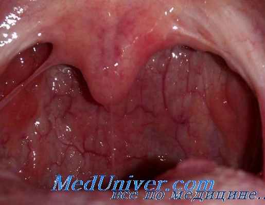 воспаление миндалин - хронический тонзиллит