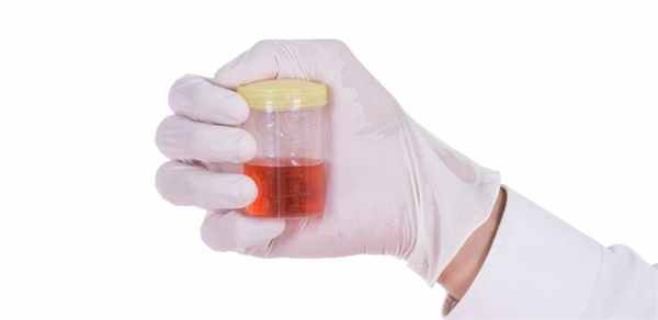 Симптом ФСГС