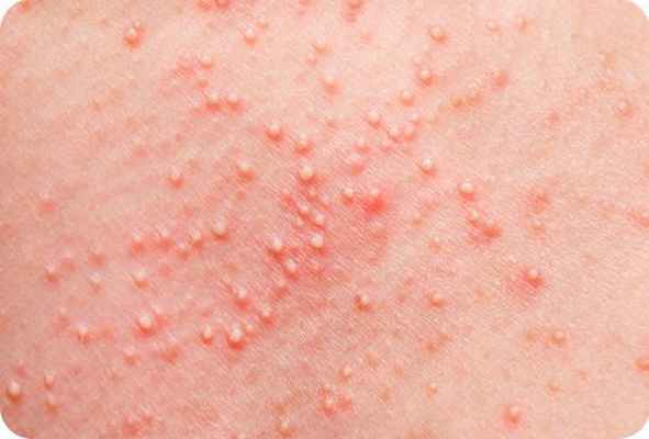 Фолликулит