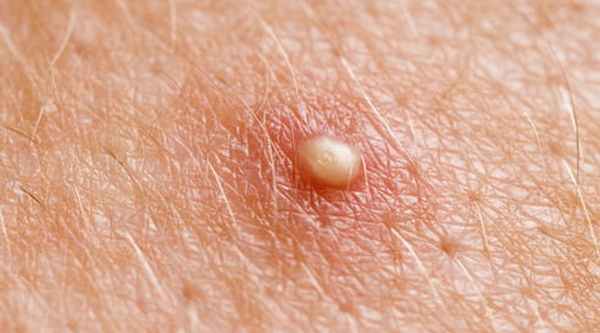 Симптомы фолликулита