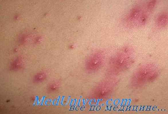 фолликулит