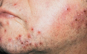 Фолликулит на лице