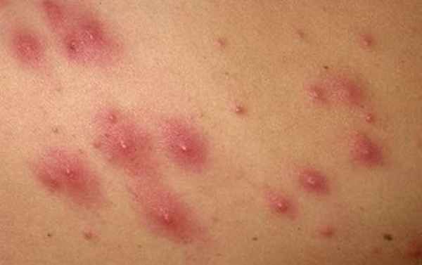 Множественный фолликулит кожи