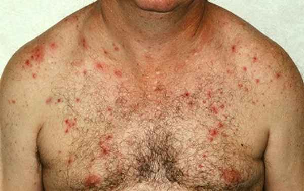 Кожное заболевание у мужчины