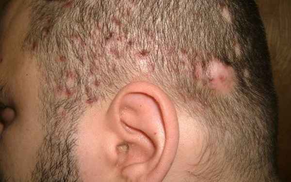 Фолликулит волосистой части головы